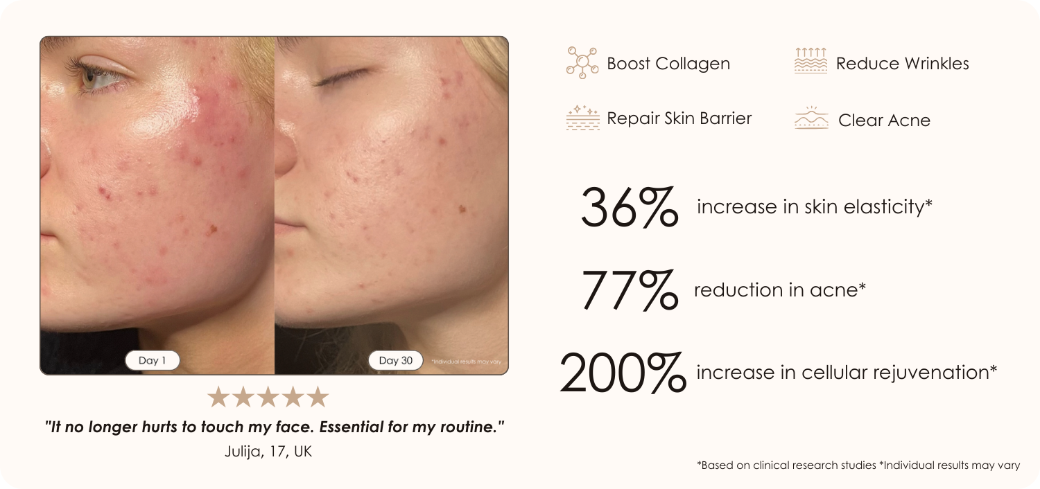 LightAura LED face mask before and after results showing improvement on mild acne and redness